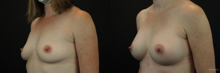 Before & After Breast Augmentation Case 213 Left Oblique View in Glen Carbon, IL