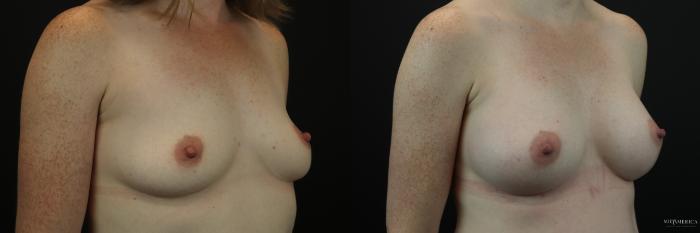 Before & After Breast Augmentation Case 213 Right Oblique View in Glen Carbon, IL
