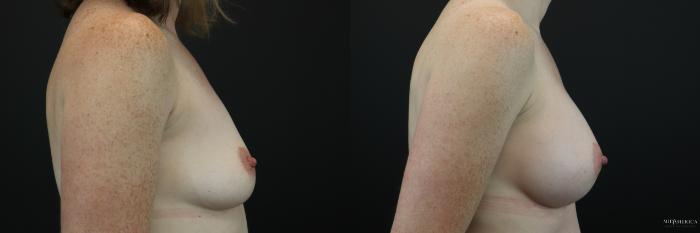 Before & After Breast Augmentation Case 213 Right Side View in Glen Carbon, IL