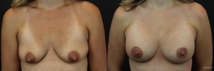 Before & After Breast Augmentation Case 236 Front View in St. Louis, MO