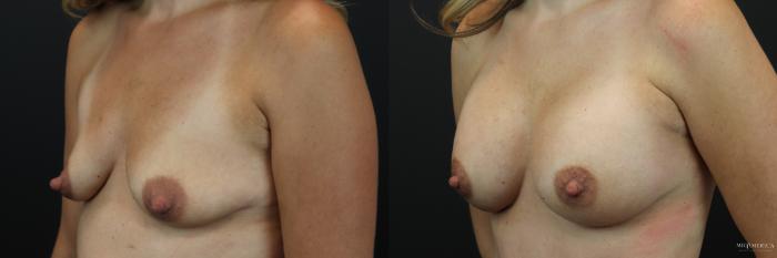 Before & After Breast Augmentation Case 236 Left Oblique View in St. Louis, MO