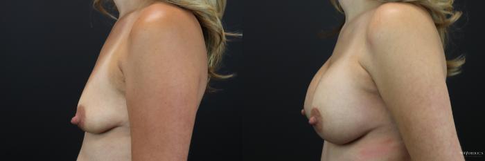 Before & After Breast Augmentation Case 236 Left Side View in St. Louis, MO