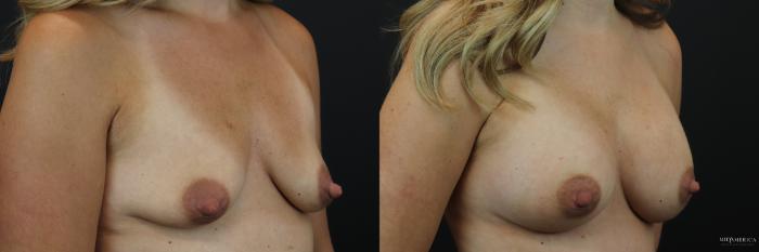 Before & After Breast Augmentation Case 236 Right Oblique View in St. Louis, MO