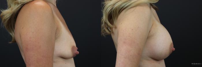 Before & After Breast Augmentation Case 236 Right Side View in St. Louis, MO