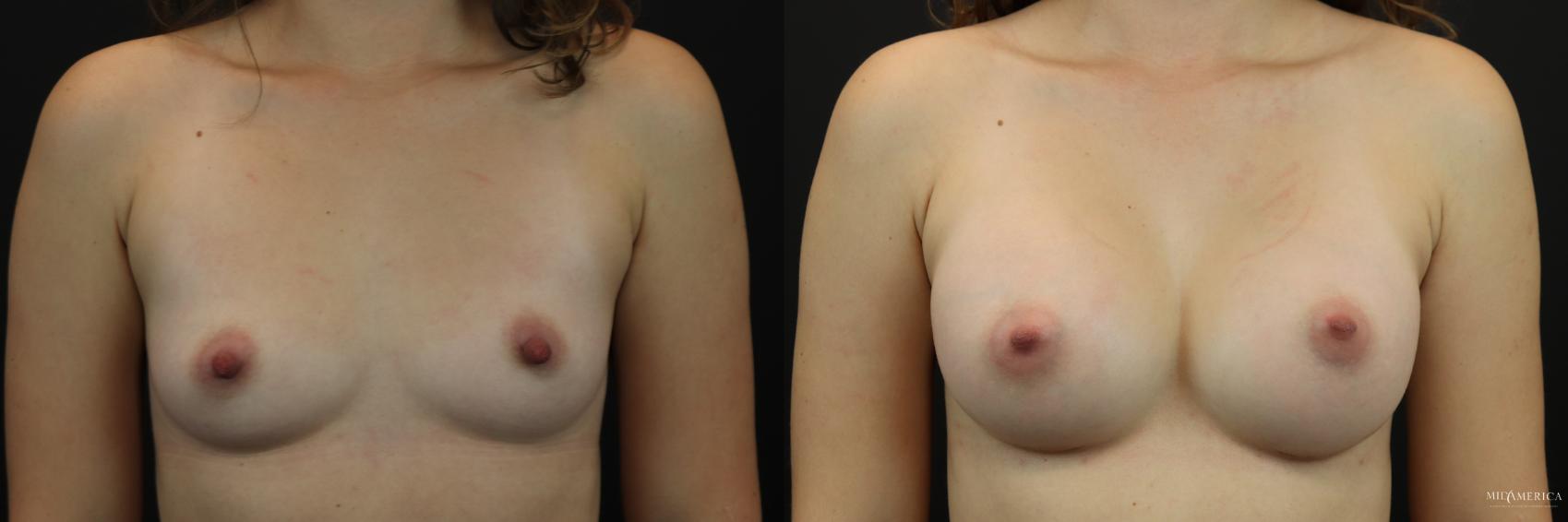 Before & After Breast Augmentation Case 247 Front View in Glen Carbon, IL