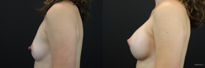 Before & After Breast Augmentation Case 247 Left Side View in Glen Carbon, IL