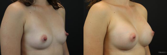 Before & After Breast Augmentation Case 247 Right Oblique View in Glen Carbon, IL