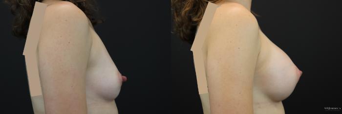 Before & After Breast Augmentation Case 247 Right Side View in Glen Carbon, IL