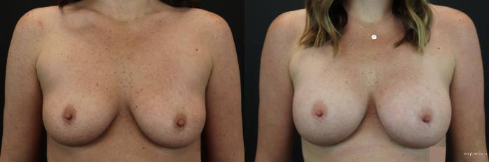 Before & After Breast Augmentation Case 249 Front View in St. Louis, MO