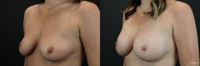 Before & After Breast Augmentation Case 249 Left Oblique View in St. Louis, MO