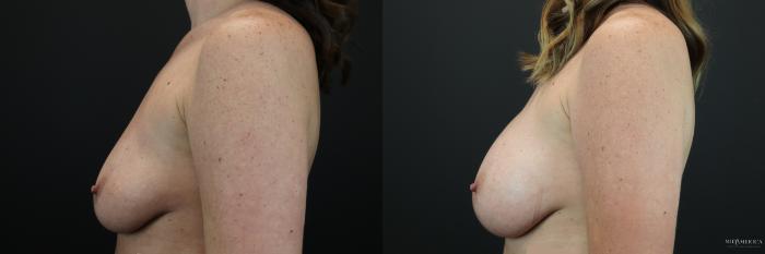 Before & After Breast Augmentation Case 249 Left Side View in St. Louis, MO