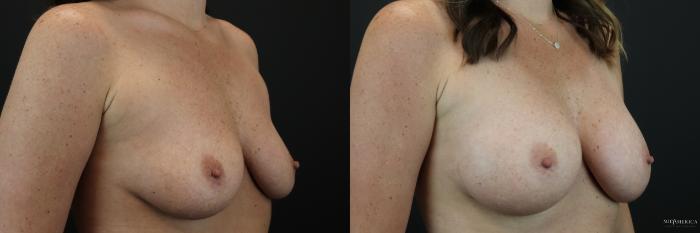 Before & After Breast Augmentation Case 249 Right Oblique View in St. Louis, MO
