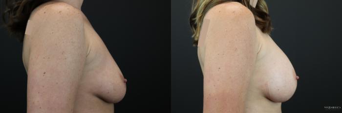 Before & After Breast Augmentation Case 249 Right Side View in St. Louis, MO