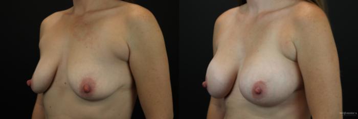 Before & After Breast Augmentation Case 251 Left Oblique View in Glen Carbon, IL