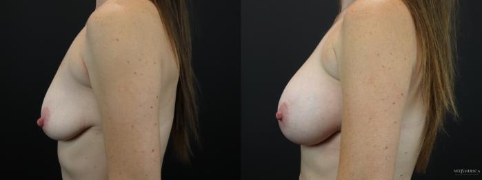 Before & After Breast Augmentation Case 251 Left Side View in Glen Carbon, IL