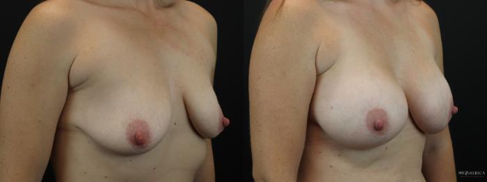 Before & After Breast Augmentation Case 251 Right Oblique View in Glen Carbon, IL