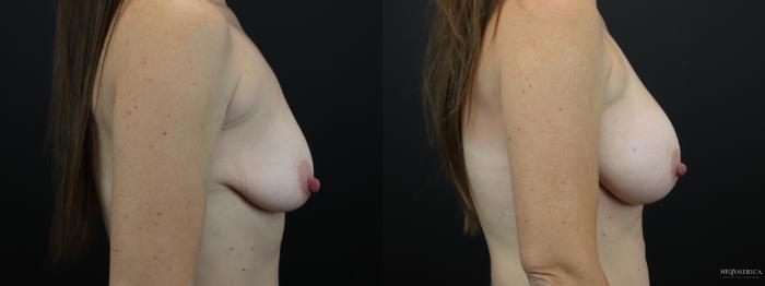 Before & After Breast Augmentation Case 251 Right Side View in Glen Carbon, IL