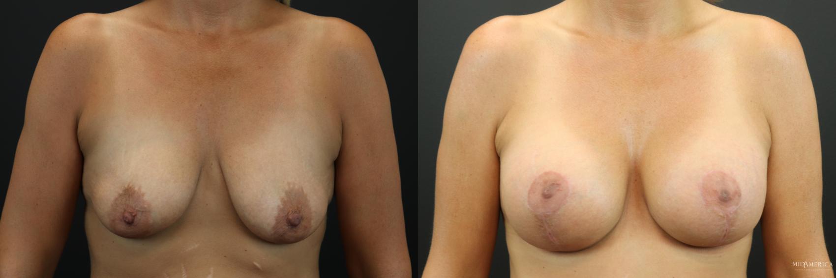 Before & After Breast Augmentation Case 252 Front View in Glen Carbon, IL