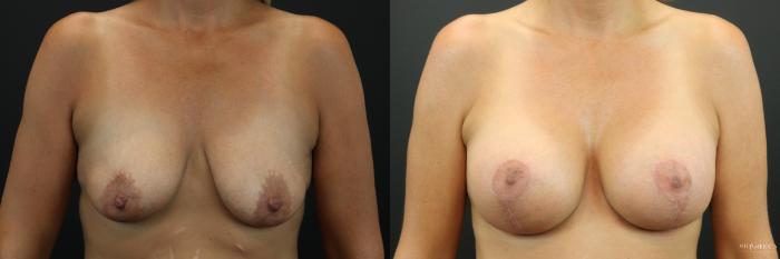 Before & After Breast Augmentation Case 252 Front View in St. Louis, MO