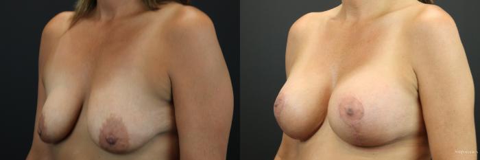 Before & After Breast Lift Case 252 Left Oblique View in St. Louis, MO