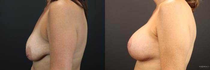 Before & After Breast Augmentation Case 252 Left Side View in St. Louis, MO