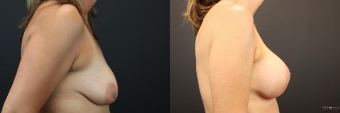 Before & After Breast Lift Case 252 Right Side View in St. Louis, MO
