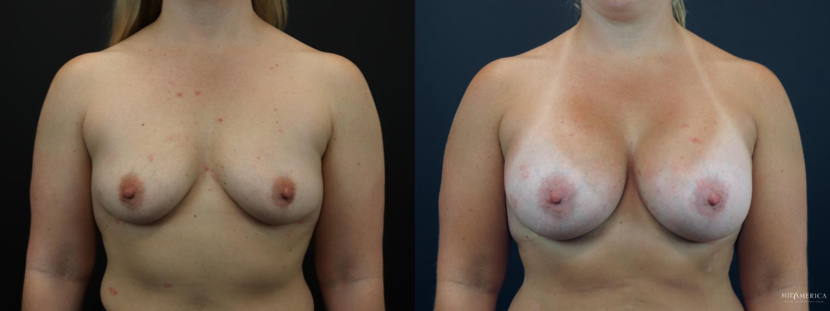 Before & After Breast Augmentation Case 258 Front View in St. Louis, MO