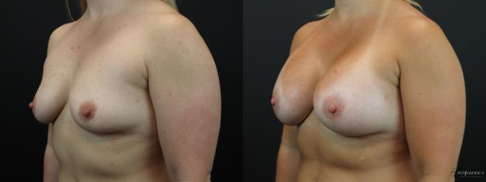Before & After Breast Augmentation Case 258 Left Oblique View in St. Louis, MO
