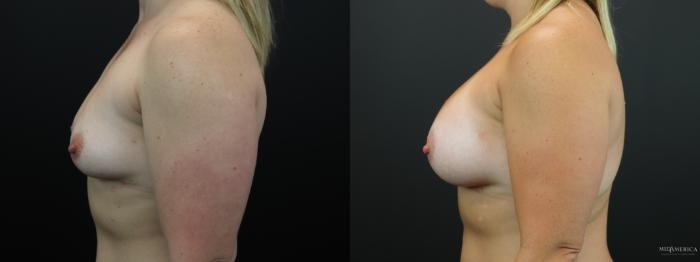 Before & After Breast Augmentation Case 258 Left Side View in St. Louis, MO