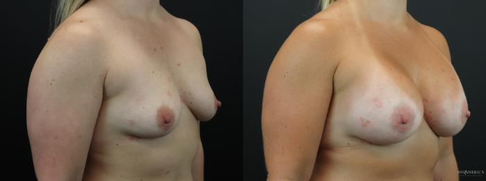 Before & After Breast Augmentation Case 258 Right Oblique View in St. Louis, MO