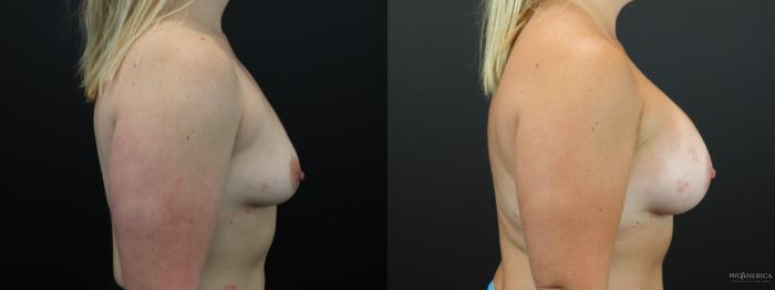 Before & After Breast Augmentation Case 258 Right Side View in St. Louis, MO