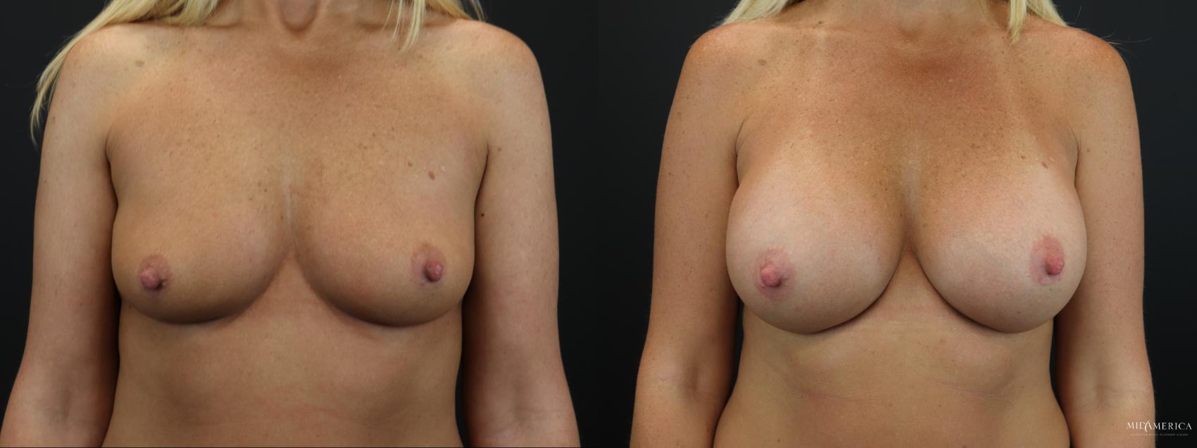Before & After Breast Augmentation Case 259 Front View in Glen Carbon, IL