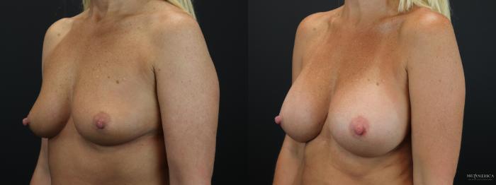 Before & After Breast Augmentation Case 259 Left Oblique View in Glen Carbon, IL