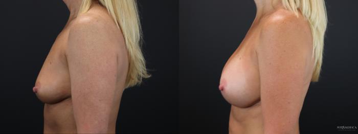 Before & After Breast Augmentation Case 259 Left Side View in Glen Carbon, IL