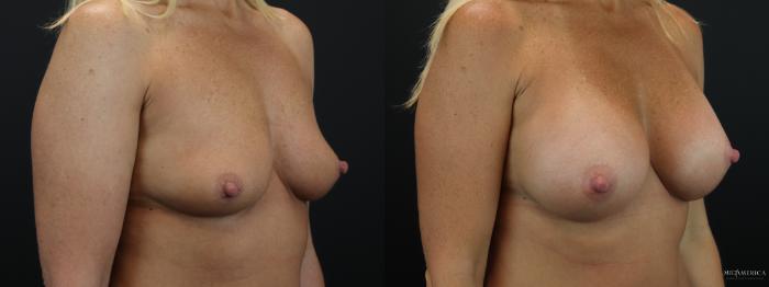 Before & After Breast Augmentation Case 259 Right Oblique View in Glen Carbon, IL