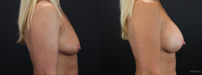 Before & After Breast Augmentation Case 259 Right Side View in Glen Carbon, IL