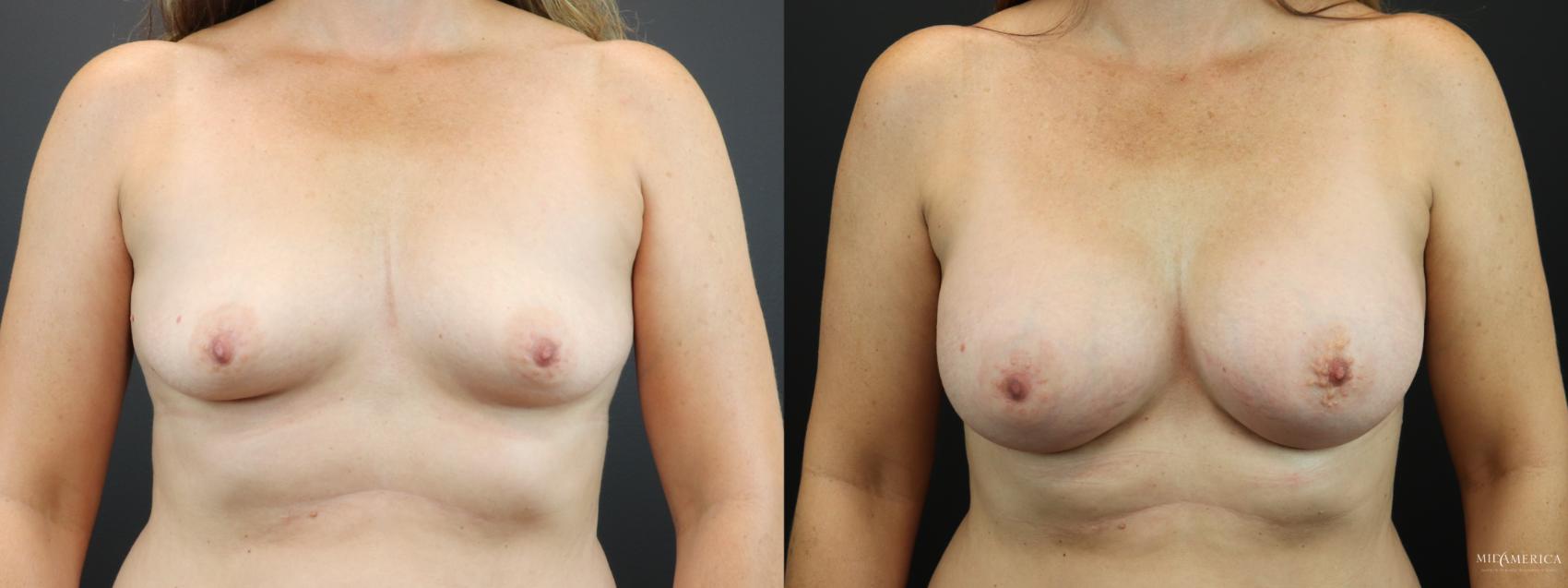 Before & After Breast Augmentation Case 265 Front View in Glen Carbon, IL