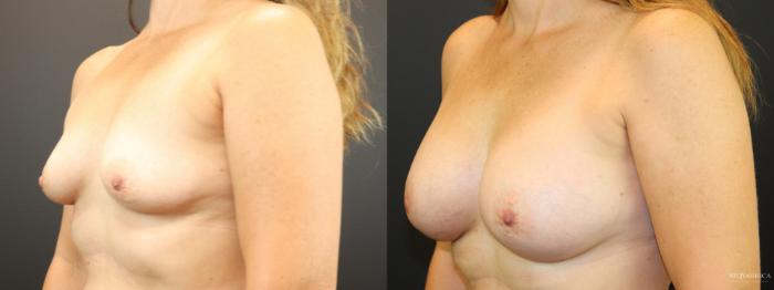 Before & After Breast Augmentation Case 265 Left Oblique View in Glen Carbon, IL