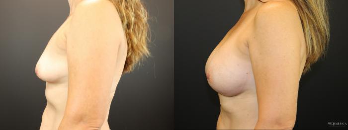 Before & After Breast Augmentation Case 265 Left Side View in Glen Carbon, IL
