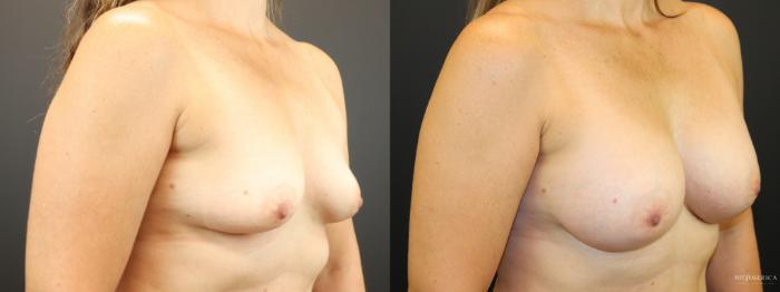 Before & After Breast Augmentation Case 265 Right Oblique View in Glen Carbon, IL