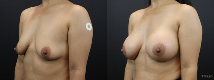 Before & After Breast Augmentation Case 266 Left Oblique View in Glen Carbon, IL
