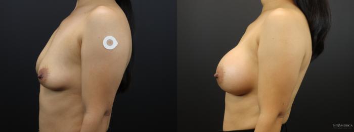 Before & After Breast Augmentation Case 266 Left Side View in Glen Carbon, IL