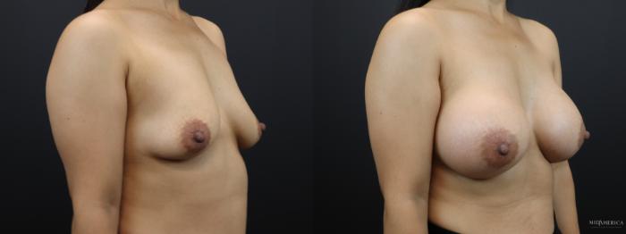 Before & After Breast Augmentation Case 266 Right Oblique View in Glen Carbon, IL