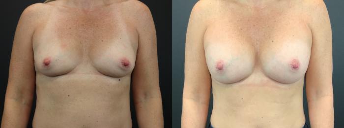 Before & After Breast Augmentation Case 268 Front View in St. Louis, MO