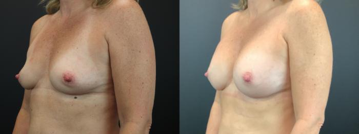 Before & After Breast Augmentation Case 268 Left Oblique View in St. Louis, MO