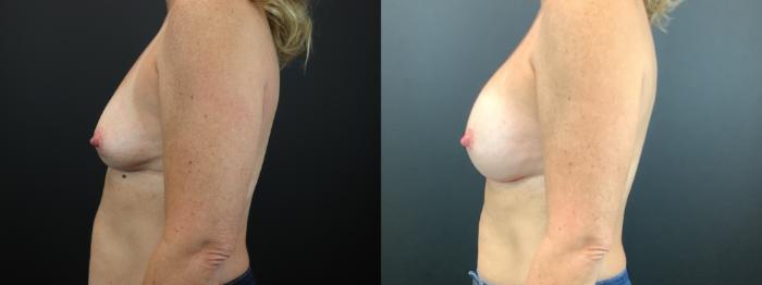 Before & After Breast Augmentation Case 268 Left Side View in St. Louis, MO