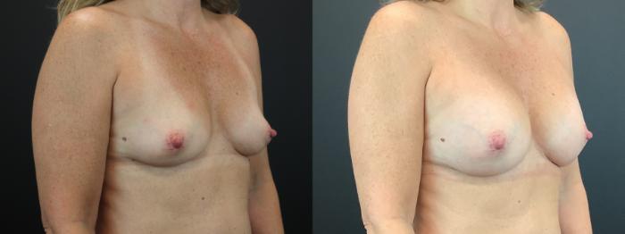 Before & After Breast Augmentation Case 268 Right Oblique View in St. Louis, MO
