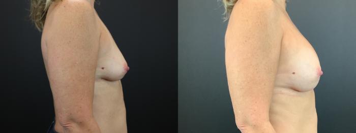 Before & After Breast Augmentation Case 268 Right Side View in St. Louis, MO