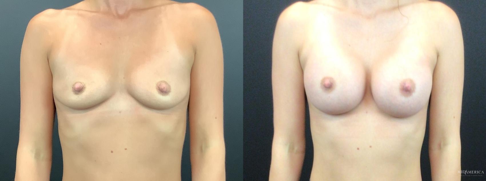 Before & After Breast Augmentation Case 269 Front View in Glen Carbon, IL