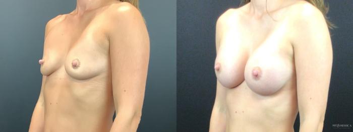 Before & After Breast Augmentation Case 269 Left Oblique View in St. Louis, MO